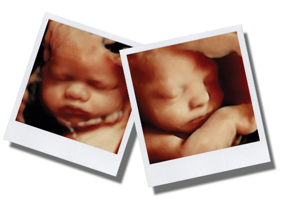 HD Ultrasound | 3D/4D HD Elective Ultrasounds | Jeffersonville
